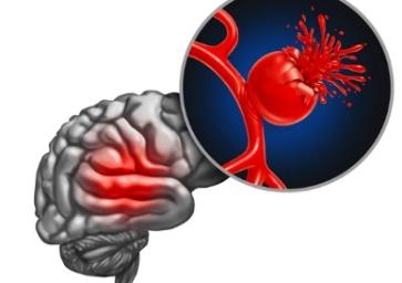 Aneurysm Clipping illustration 1