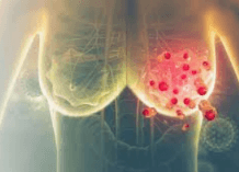 Sentinel Lymph Node Biopsy (SLNB) illustration 1