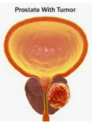 Urologic Oncology Surgery illustration 1