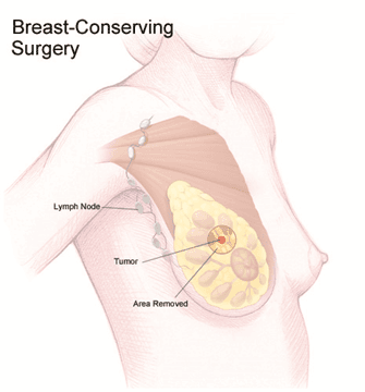 Breast Conserving Surgery (BCS) illustration 1