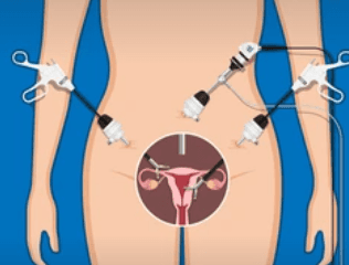 Laparoscopic Cancer Surgery illustration 4