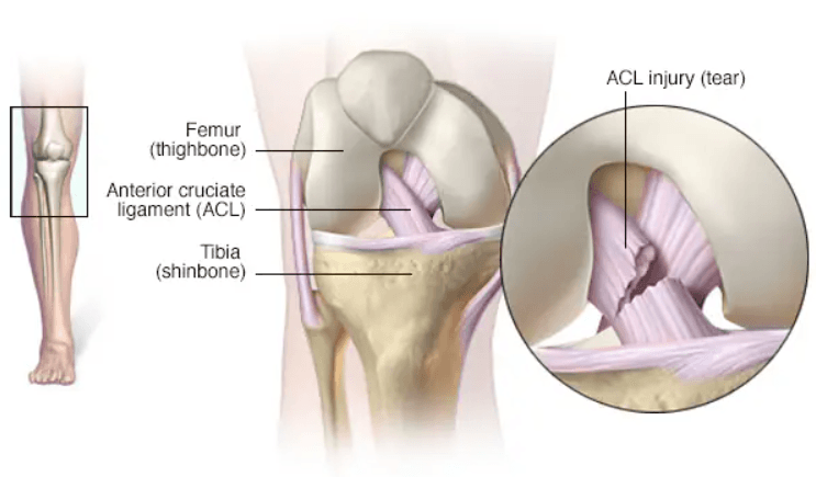 ACL Tear & Ligament Injuries illustration 1
