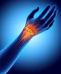 Carpal Tunnel Syndrome illustration 1