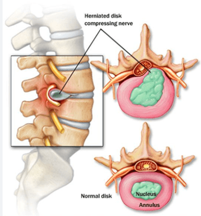 Herniated Disc (Slipped Disc) illustration 1