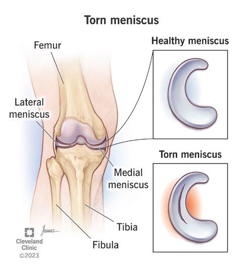 Meniscus Tear illustration 1