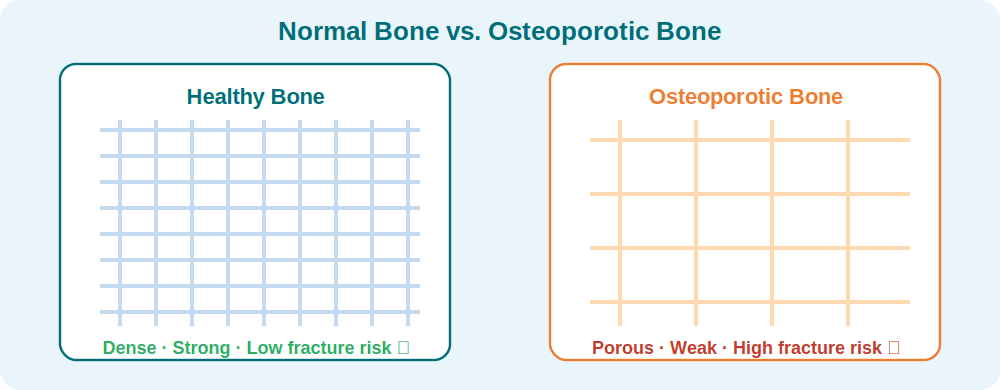 Osteoporosis illustration 1
