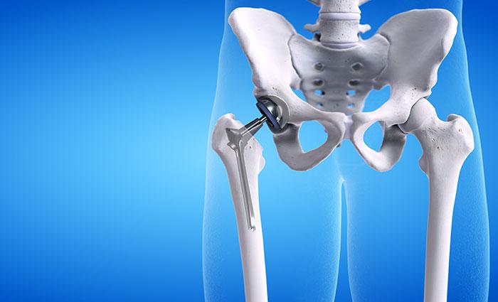 Total Hip Replacement illustration 1